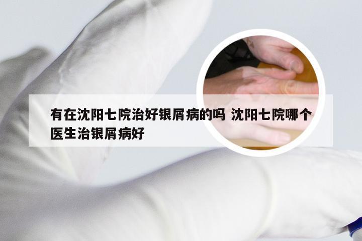 有在沈阳七院治好银屑病的吗 沈阳七院哪个医生治银屑病好