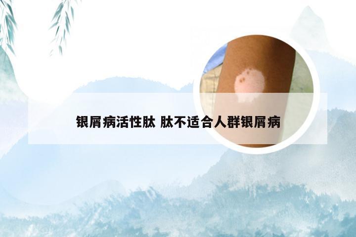 银屑病活性肽 肽不适合人群银屑病