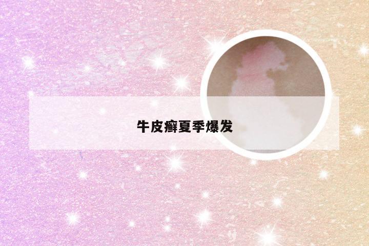 牛皮癣夏季爆发