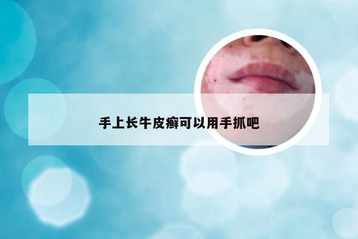 手上长牛皮癣可以用手抓吧