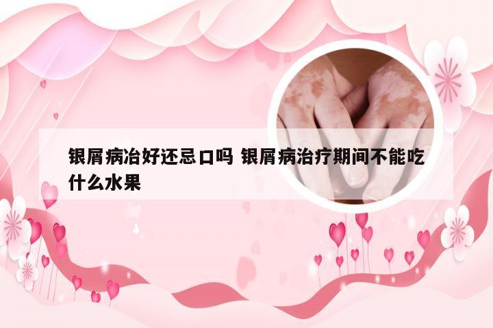 银屑病冶好还忌口吗 银屑病治疗期间不能吃什么水果