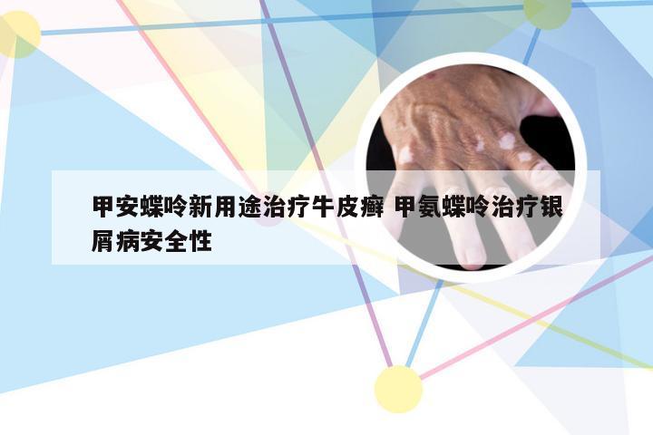 甲安蝶呤新用途治疗牛皮癣 甲氨蝶呤治疗银屑病安全性