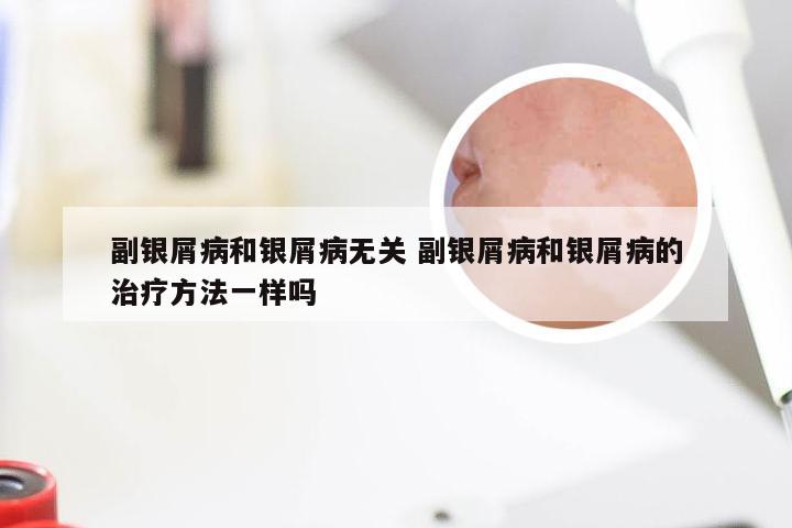 副银屑病和银屑病无关 副银屑病和银屑病的治疗方法一样吗
