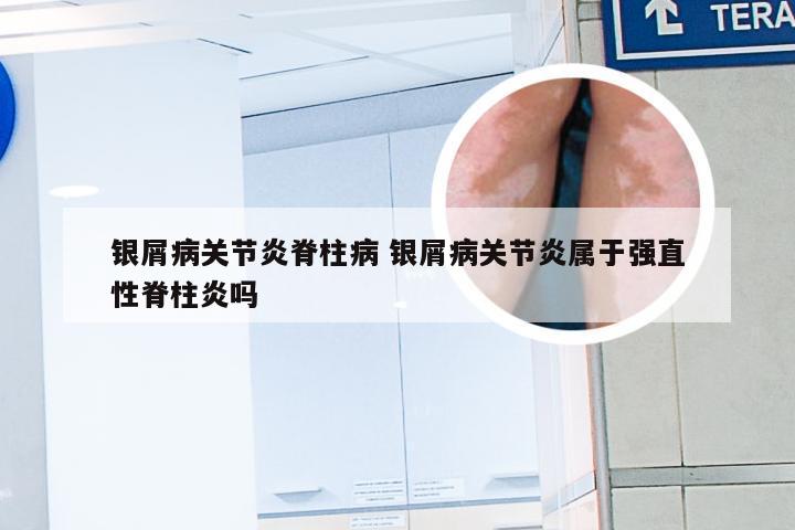 银屑病关节炎脊柱病 银屑病关节炎属于强直性脊柱炎吗