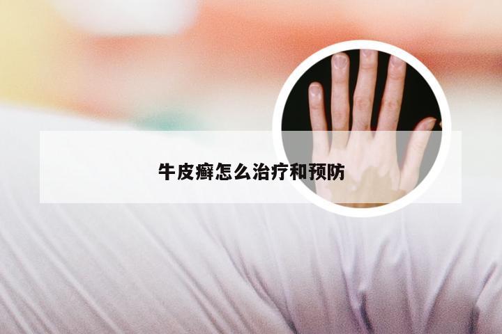 牛皮癣怎么治疗和预防