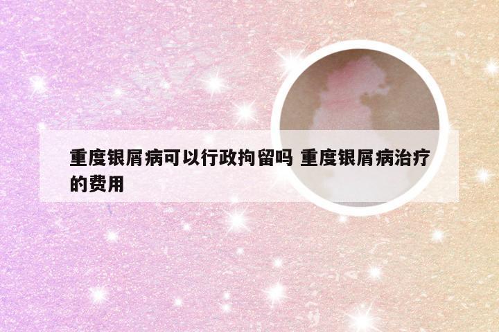 重度银屑病可以行政拘留吗 重度银屑病治疗的费用
