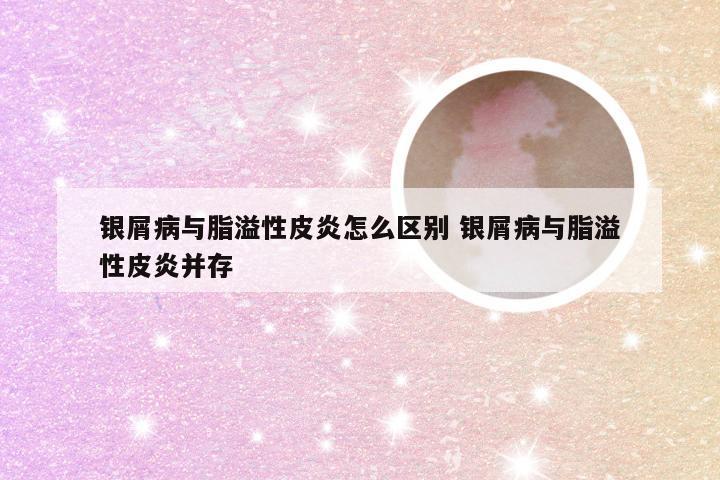 银屑病与脂溢性皮炎怎么区别 银屑病与脂溢性皮炎并存