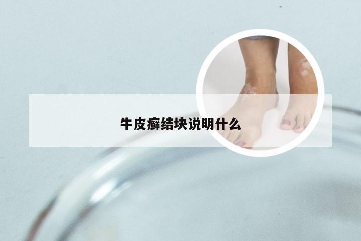 牛皮癣结块说明什么
