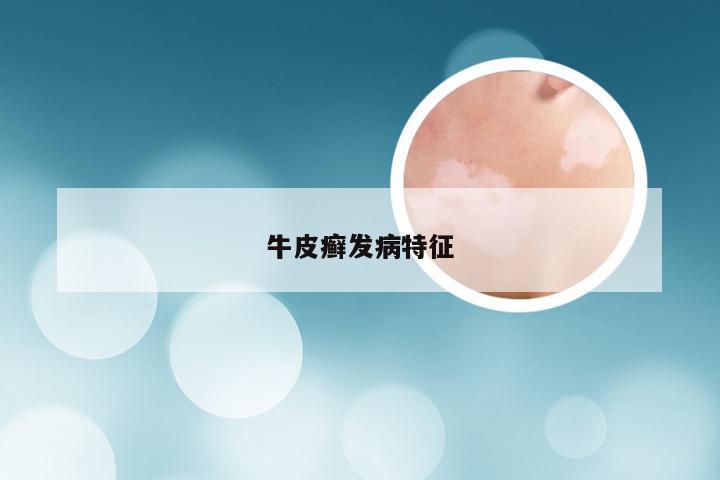 牛皮癣发病特征