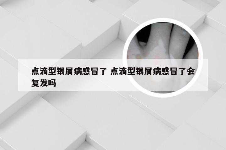 点滴型银屑病感冒了 点滴型银屑病感冒了会复发吗