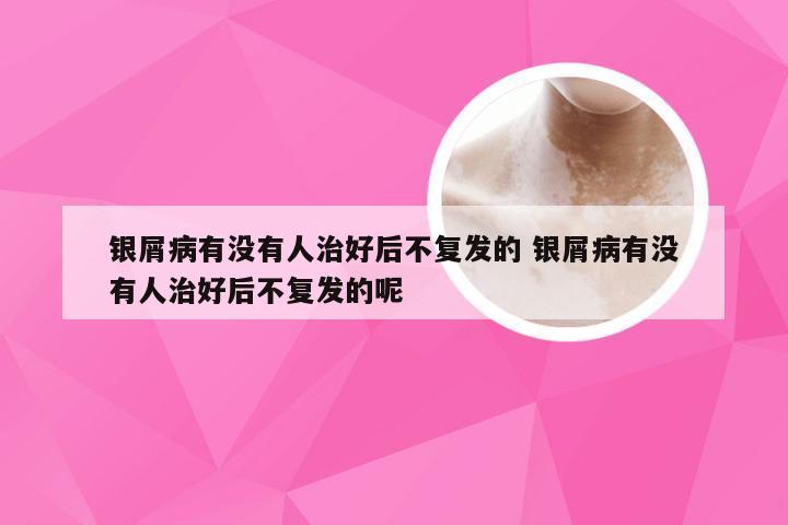 银屑病有没有人治好后不复发的 银屑病有没有人治好后不复发的呢