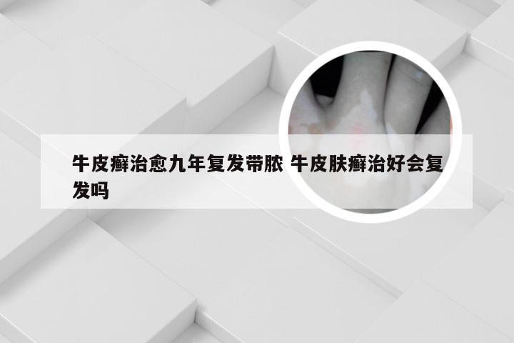牛皮癣治愈九年复发带脓 牛皮肤癣治好会复发吗