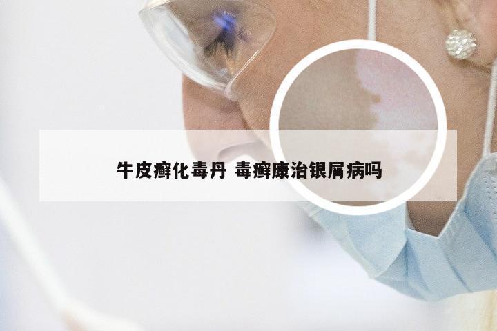 牛皮癣化毒丹 毒癣康治银屑病吗