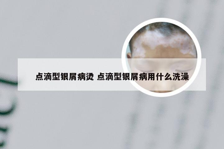 点滴型银屑病烫 点滴型银屑病用什么洗澡