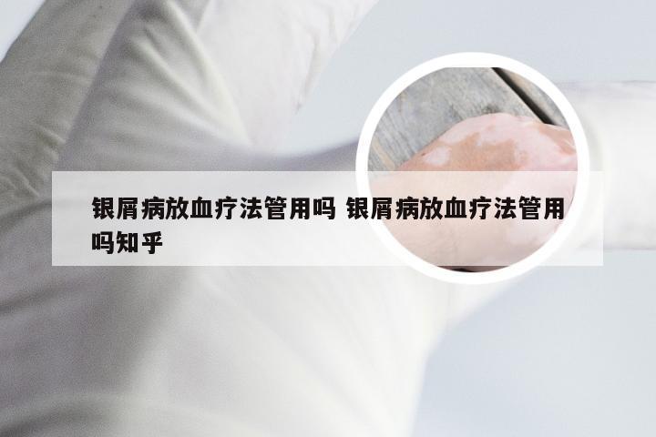 银屑病放血疗法管用吗 银屑病放血疗法管用吗知乎