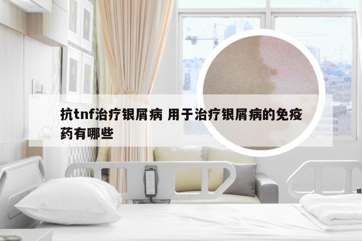 抗tnf治疗银屑病 用于治疗银屑病的免疫药有哪些