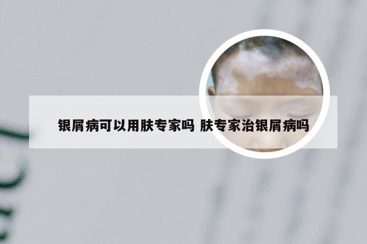 银屑病可以用肤专家吗 肤专家治银屑病吗