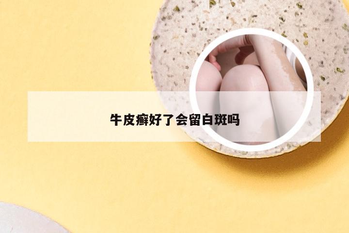 牛皮癣好了会留白斑吗