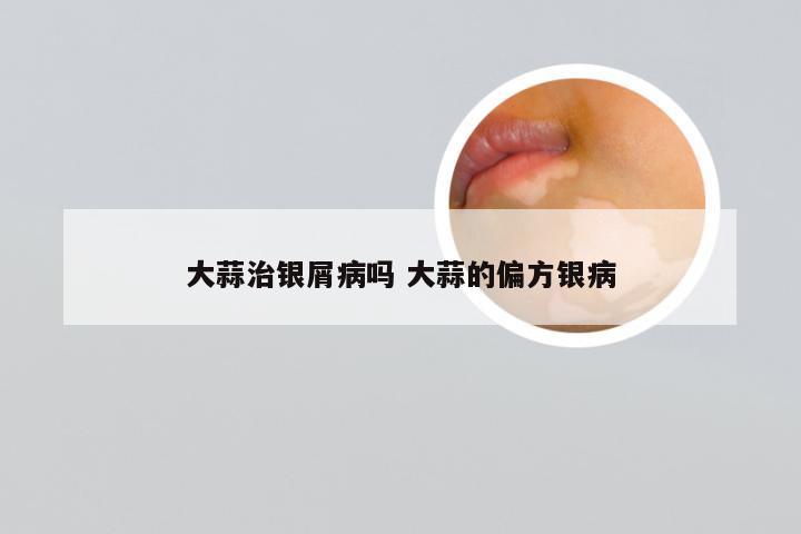 大蒜治银屑病吗 大蒜的偏方银病