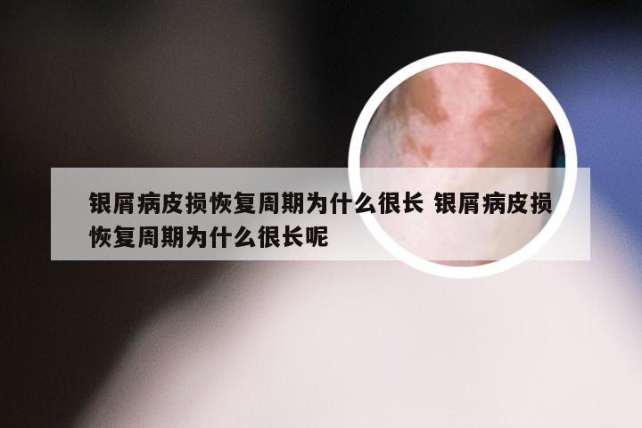 银屑病皮损恢复周期为什么很长 银屑病皮损恢复周期为什么很长呢