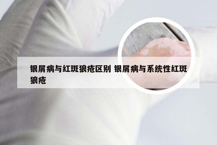 银屑病与红斑狼疮区别 银屑病与系统性红斑狼疮