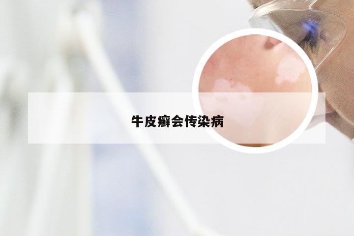 牛皮癣会传染病
