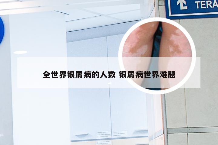 全世界银屑病的人数 银屑病世界难题