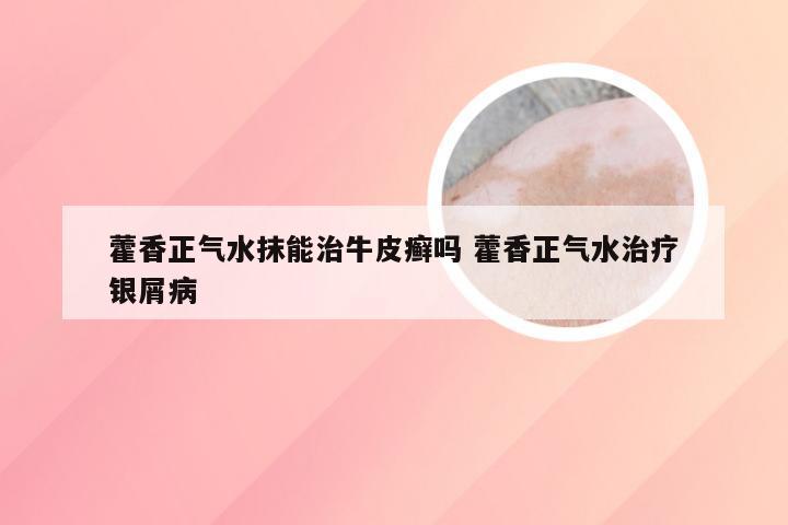 藿香正气水抹能治牛皮癣吗 藿香正气水治疗银屑病