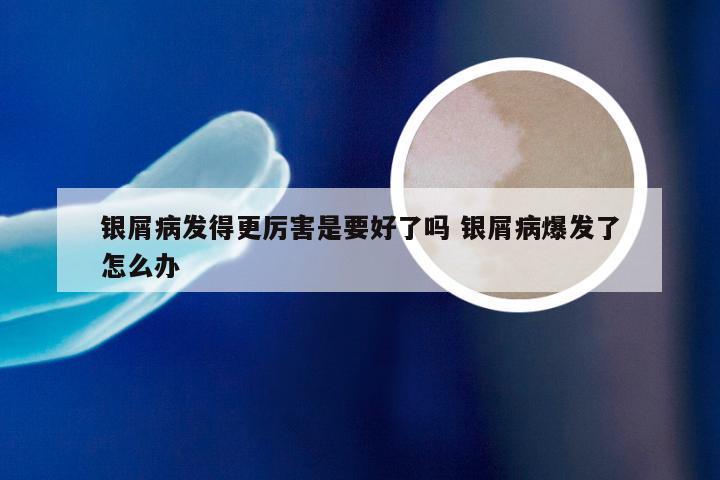 银屑病发得更厉害是要好了吗 银屑病爆发了怎么办