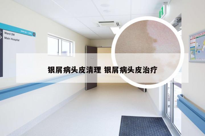银屑病头皮清理 银屑病头皮治疗