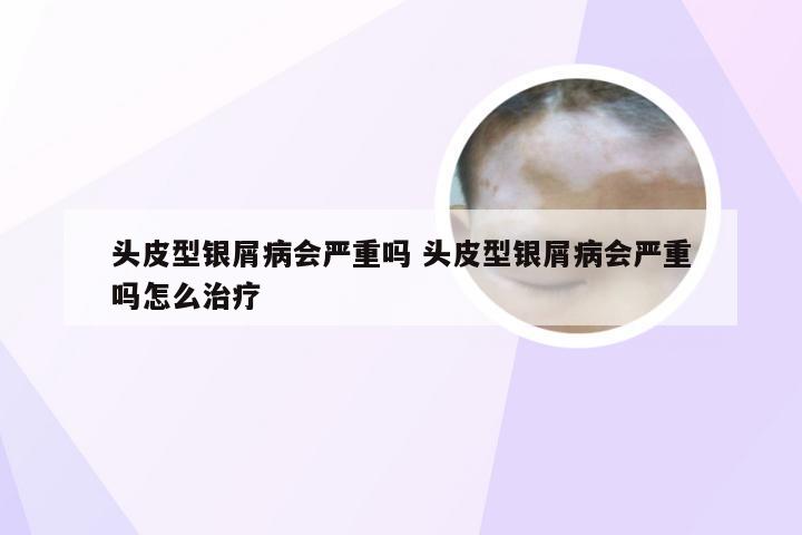 头皮型银屑病会严重吗 头皮型银屑病会严重吗怎么治疗