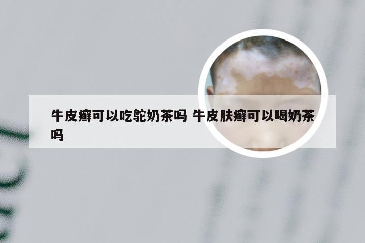 牛皮癣可以吃鸵奶茶吗 牛皮肤癣可以喝奶茶吗
