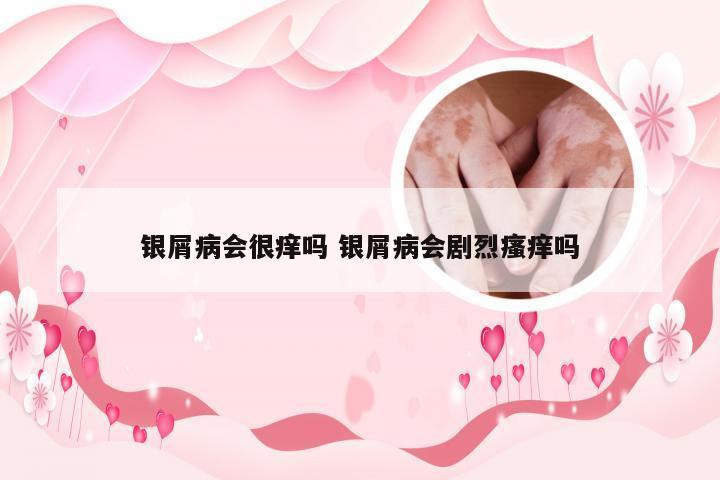 银屑病会很痒吗 银屑病会剧烈瘙痒吗