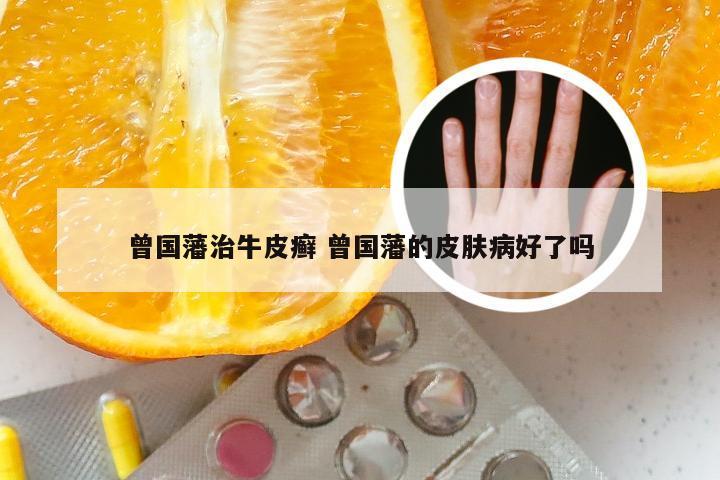 曾国藩治牛皮癣 曾国藩的皮肤病好了吗