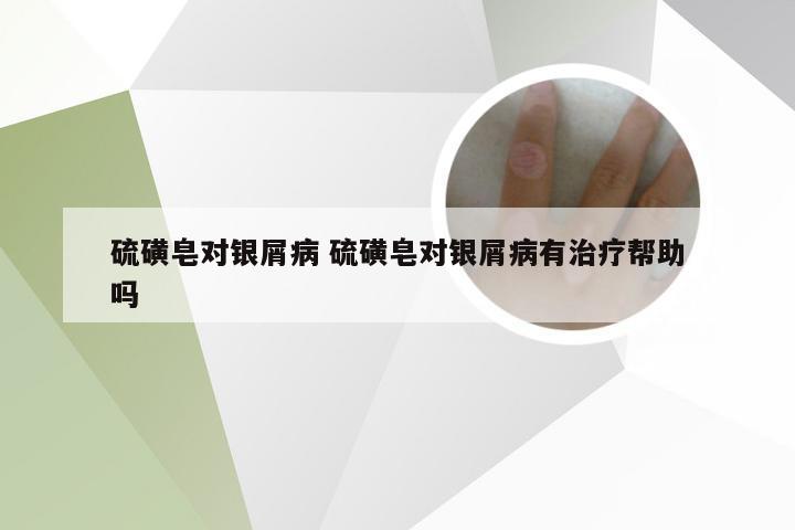 硫磺皂对银屑病 硫磺皂对银屑病有治疗帮助吗