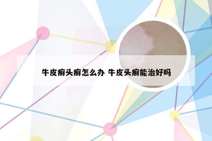 牛皮癣头癣怎么办 牛皮头癣能治好吗