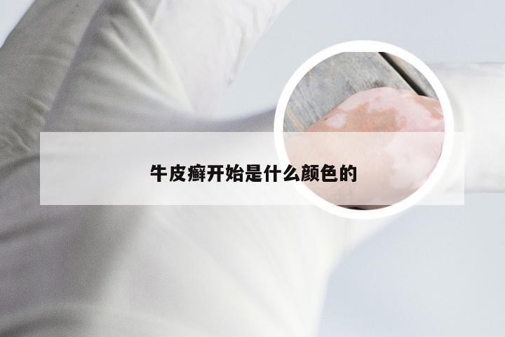 牛皮癣开始是什么颜色的