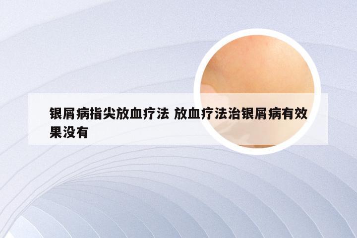 银屑病指尖放血疗法 放血疗法治银屑病有效果没有