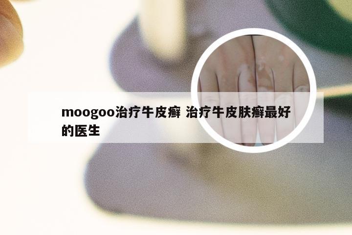 moogoo治疗牛皮癣 治疗牛皮肤癣最好的医生