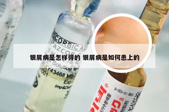 银屑病是怎样得的 银屑病是如何患上的