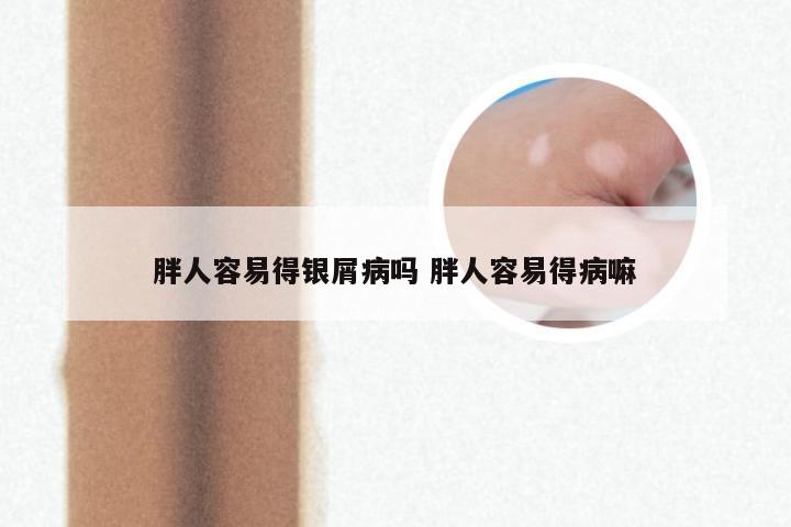 胖人容易得银屑病吗 胖人容易得病嘛