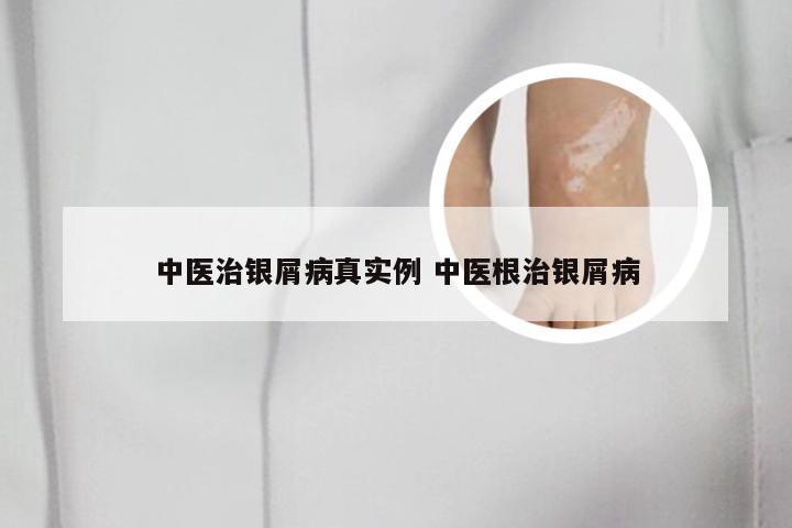 中医治银屑病真实例 中医根治银屑病