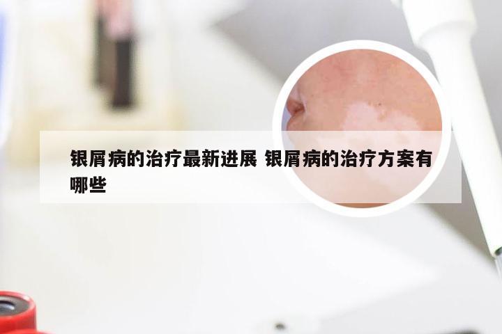 银屑病的治疗最新进展 银屑病的治疗方案有哪些