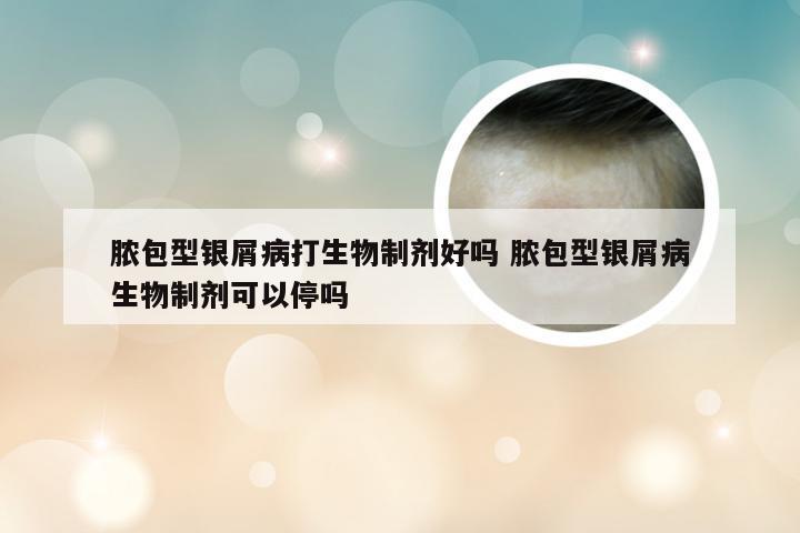 脓包型银屑病打生物制剂好吗 脓包型银屑病生物制剂可以停吗