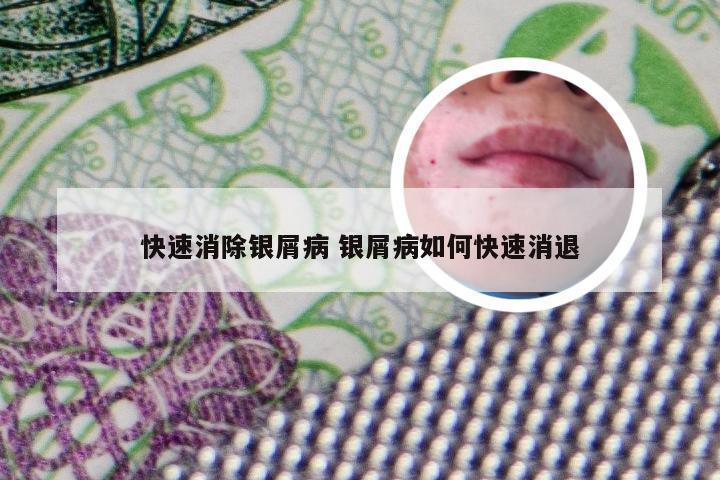 快速消除银屑病 银屑病如何快速消退