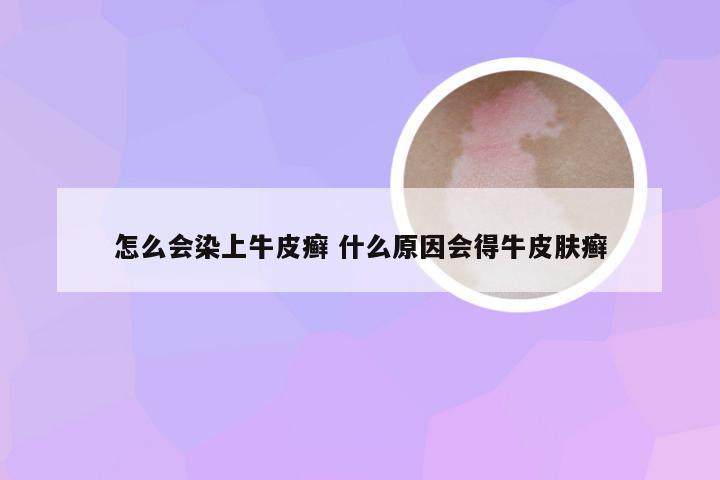 怎么会染上牛皮癣 什么原因会得牛皮肤癣