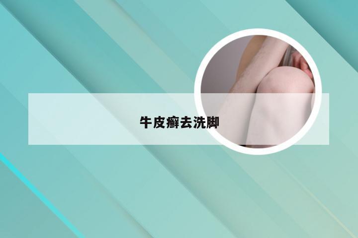 牛皮癣去洗脚