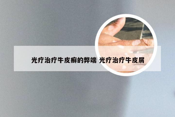 光疗治疗牛皮癣的弊端 光疗治疗牛皮屑