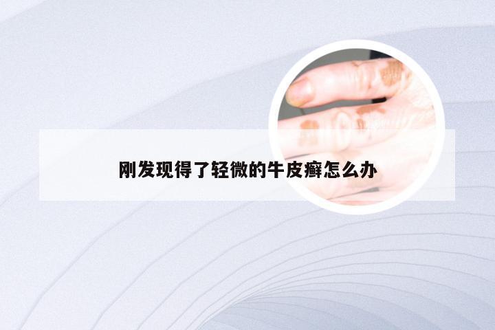 刚发现得了轻微的牛皮癣怎么办