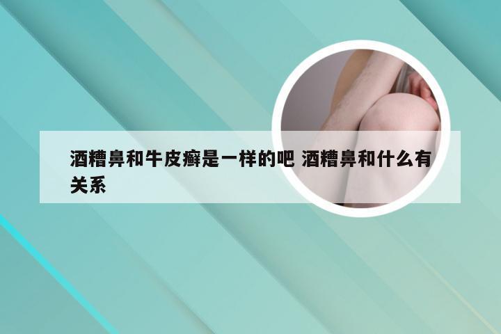 酒糟鼻和牛皮癣是一样的吧 酒糟鼻和什么有关系